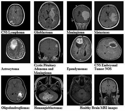 An enhanced pattern detection and segmentation of brain tumors in MRI images using deep learning technique